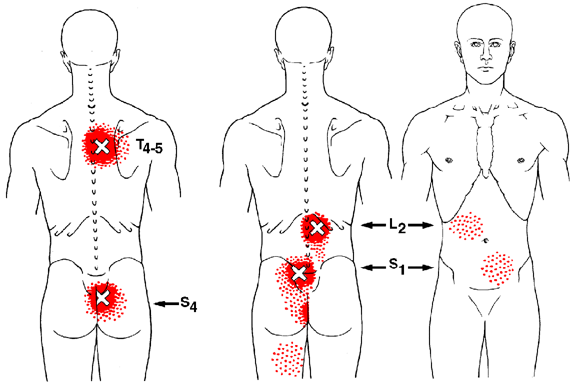 Multifidi The Trigger Point & Referred Pain Guide